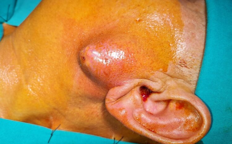  Tükrük bezi kitleleri 