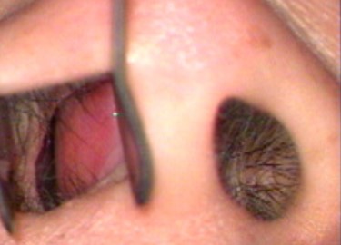  Burun tıkanıklığı 